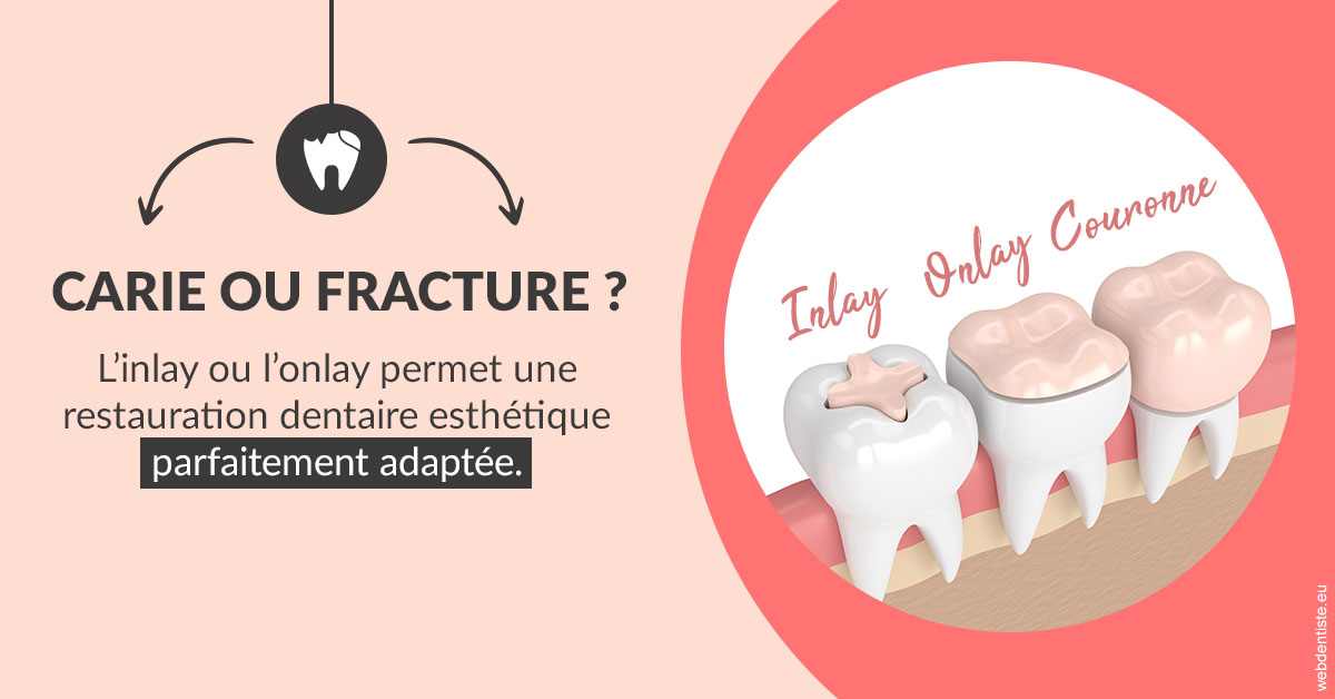 https://dr-goffoz-jf.chirurgiens-dentistes.fr/T2 2023 - Carie ou fracture 2