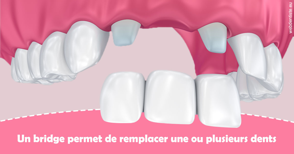 https://dr-goffoz-jf.chirurgiens-dentistes.fr/Bridge remplacer dents 2