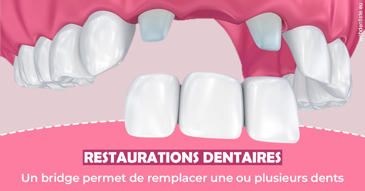 https://dr-goffoz-jf.chirurgiens-dentistes.fr/Bridge remplacer dents 2