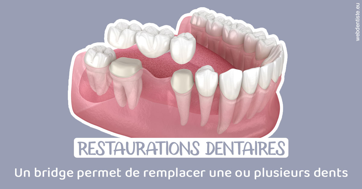 https://dr-goffoz-jf.chirurgiens-dentistes.fr/Bridge remplacer dents 1