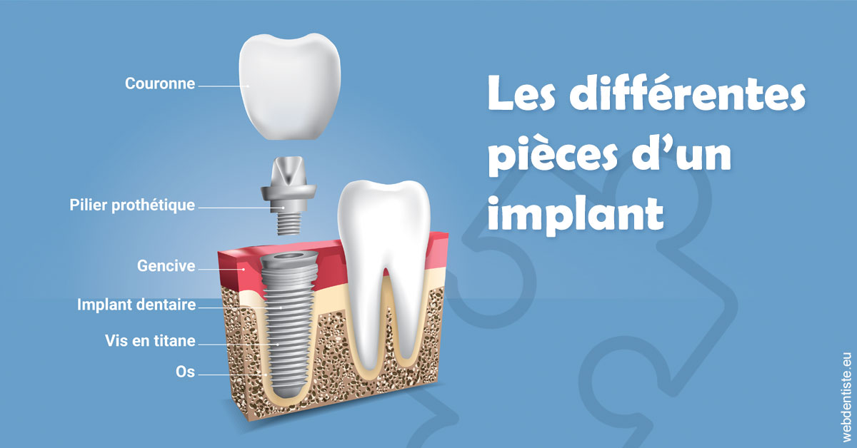 https://dr-goffoz-jf.chirurgiens-dentistes.fr/Les différentes pièces d’un implant 1