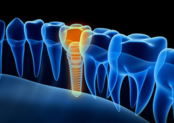 Implantologie au cabinet dentaire du Dr Goffoz à Lyon (69)